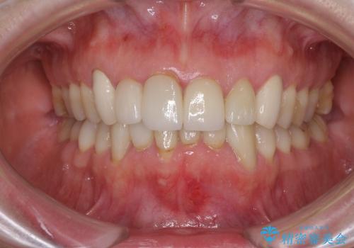 偽物のような白さはイヤ　自然な前歯をオールセラミックでの治療前