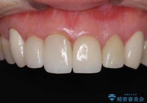 偽物のような白さはイヤ　自然な前歯をオールセラミックでの治療前