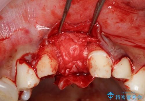 30代男性　前歯のへこみ　骨の移植で改善の治療中