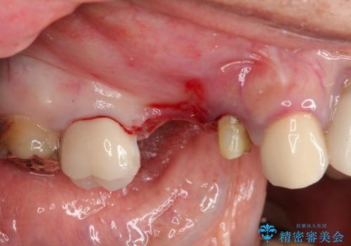 ブリッジの土台の歯が割れた　インプラントによる奥歯の補綴治療の治療前