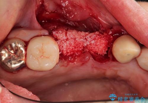 ブリッジの土台の歯が割れた　インプラントによる奥歯の補綴治療の治療中