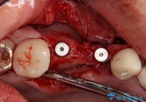 ブリッジの土台の歯が割れた　インプラントによる奥歯の補綴治療の治療中