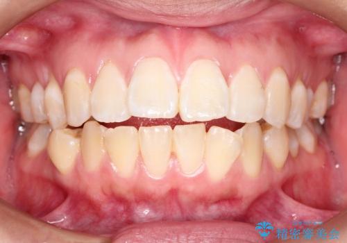 30代女性　前歯の裏側部分矯正の治療前