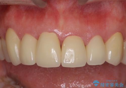 偽物のような白さはイヤ　自然な前歯をオールセラミックでの治療後