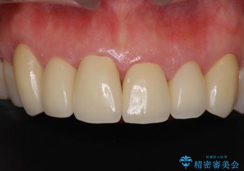 偽物のような白さはイヤ　自然な前歯をオールセラミックでの治療後