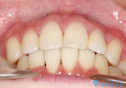 20代女性　ハーフリンガル　出っ歯の改善の治療後