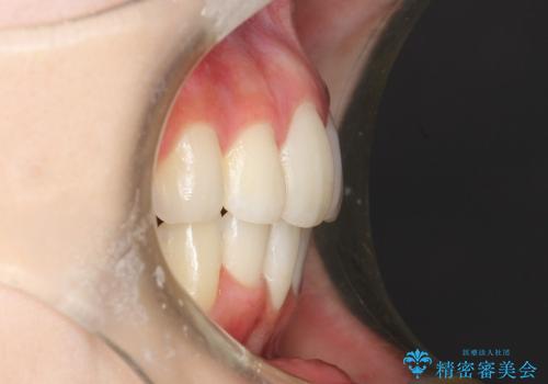 20代女性　ハーフリンガル　出っ歯の改善の治療後