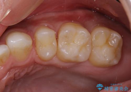 20代男性　セラミックインレーによる歯の形態修復の治療前