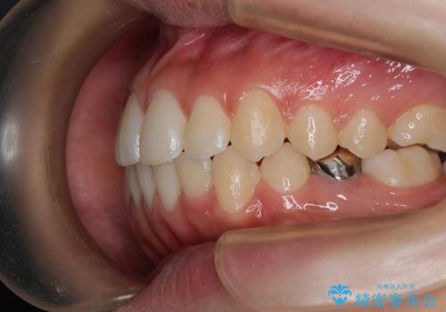インビザラインによる前歯の反対に並んでいる歯の矯正の治療後