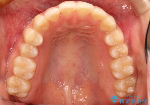 インビザラインによる前歯の反対に並んでいる歯の矯正の治療後