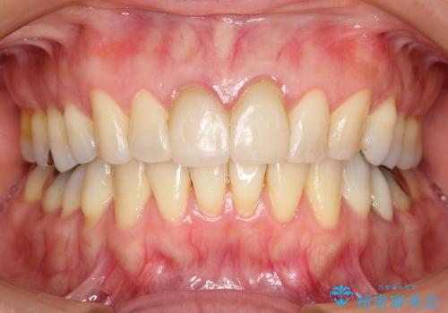 30代女性　矯正後の前歯の完成の治療前
