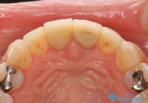 30代女性　矯正後の前歯の完成の治療前