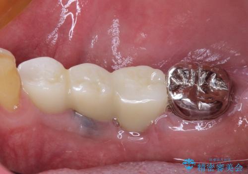 40代男性　奥歯のインプラント　の治療後