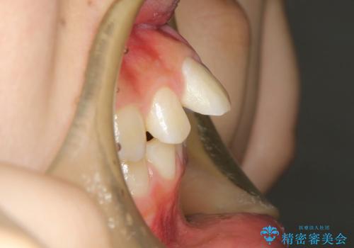 20代女性　ハーフリンガル　出っ歯の解消の治療前