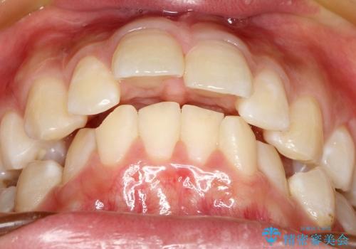 20代女性　ハーフリンガル　出っ歯の解消の治療前