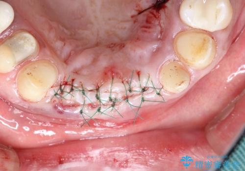 前歯の抜歯、歯茎を再生してブリッジで治すの治療中