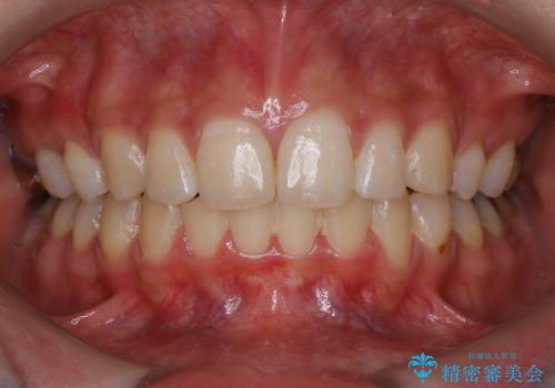 20代女性　ハーフリンガル　出っ歯の解消の治療後