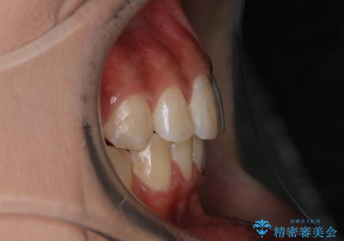 20代女性　ハーフリンガル　出っ歯の解消の治療後