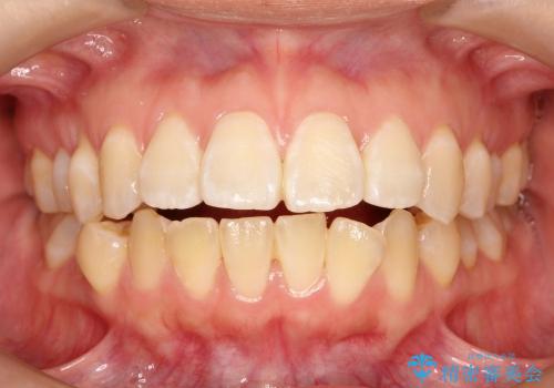 30代女性　前歯の裏側部分矯正の治療中