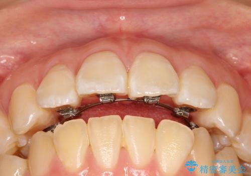 30代女性　前歯の裏側部分矯正の治療中