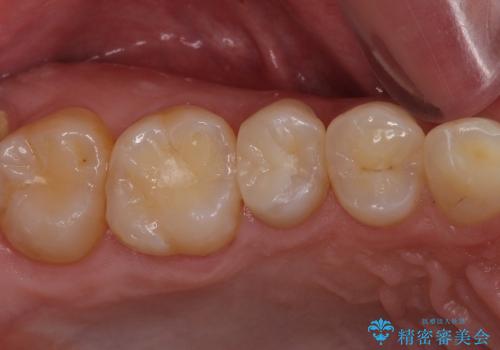 フロスが引っかかり始めたら治療のサイン　セラミックインレーによるむし歯治療の治療後
