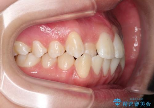 インビザラインによる前歯の反対に並んでいる歯の矯正の治療前