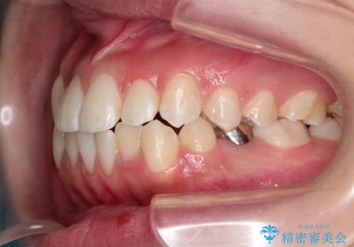 インビザラインによる前歯の反対に並んでいる歯の矯正の治療前