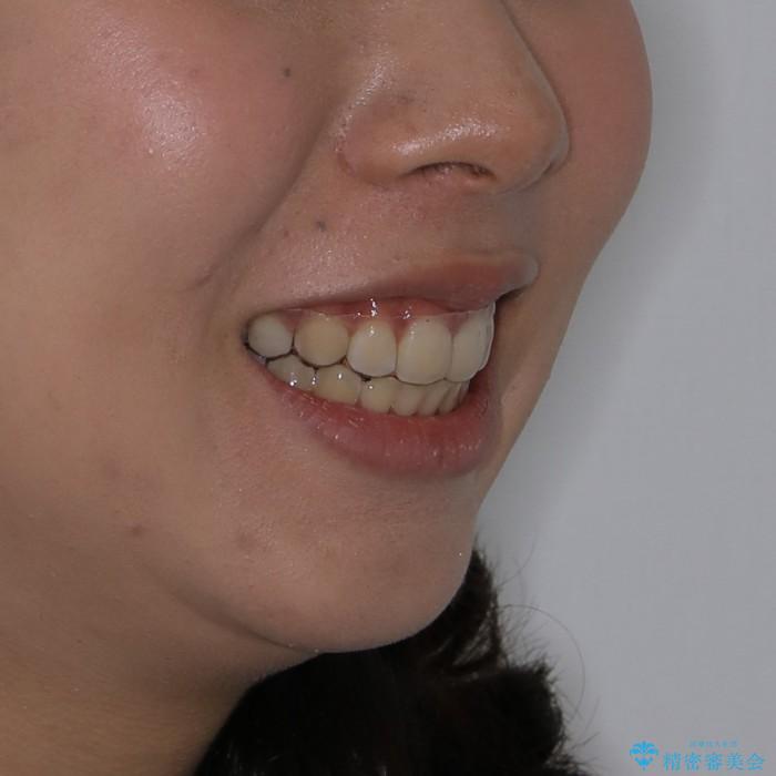 20代女性　ハーフリンガル　出っ歯の解消の治療後（顔貌）