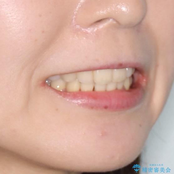 20代女性　ハーフリンガル　出っ歯の改善の治療後（顔貌）