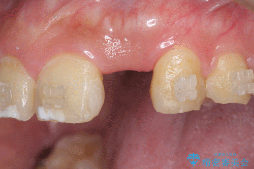 [前歯部インプラント] 前歯がないインプラントによる前歯部審美回復