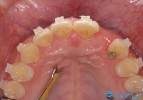 [前歯部インプラント] 前歯がないインプラントによる前歯部審美回復の治療前