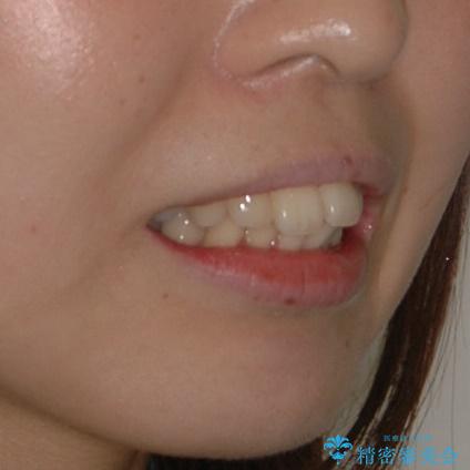 20代女性　ハーフリンガル　出っ歯の改善の治療前（顔貌）