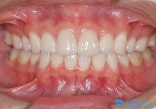 [審美治療] 歯の白斑の治療の治療後