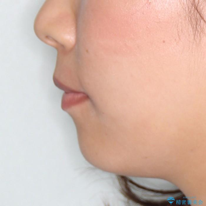 20代女性　ハーフリンガル　上下前突の改善の治療後（顔貌）
