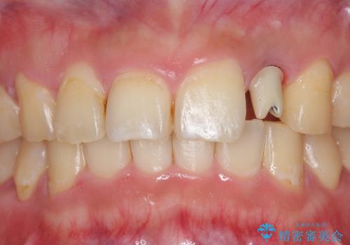 [前歯部インプラント] 前歯がないインプラントによる前歯部審美回復の治療中