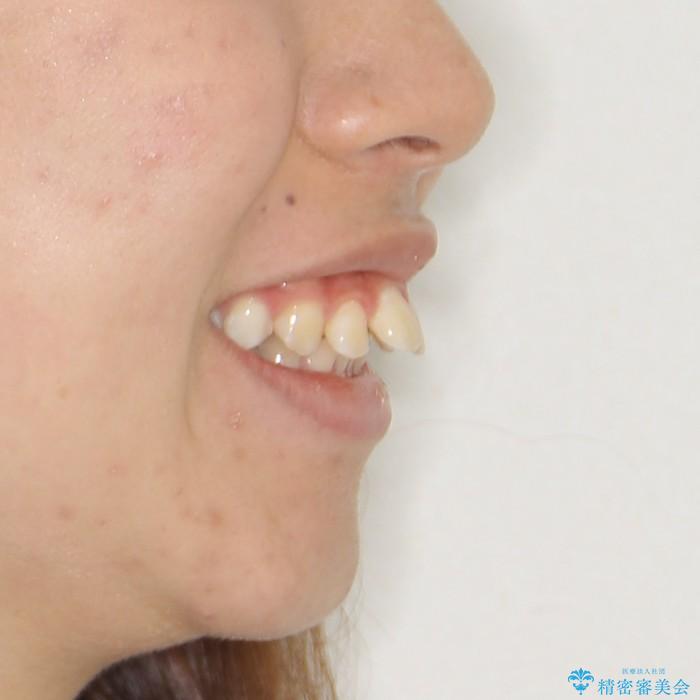 20代女性　ハーフリンガル　出っ歯の解消の治療前（顔貌）