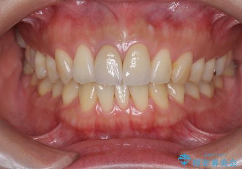 [顕微鏡治療]  前歯部精密審美オールセラミック治療の治療後
