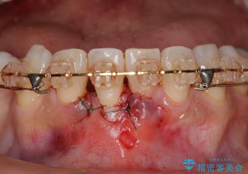 [歯ぐきの再生] 矯正治療中に起きた歯肉退縮に対する歯肉移植の治療中