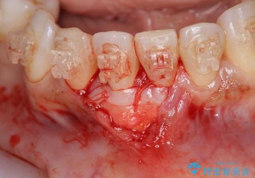 [歯ぐきの再生] 矯正治療中に起きた歯肉退縮に対する歯肉移植