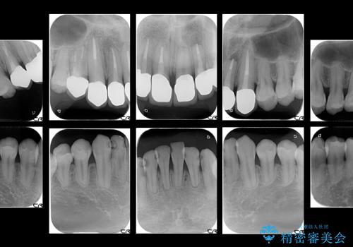 銀歯と虫歯を白くしたいの治療後