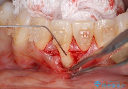 [歯ぐきの再生] 矯正治療中に起きた歯肉退縮に対する歯肉移植の治療中