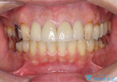 [前歯部審美治療] 保険適応クラウンのジルコニアクラウンへのやりかえの治療後