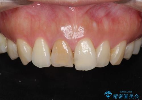 [顕微鏡治療]  前歯部精密審美オールセラミック治療の治療前