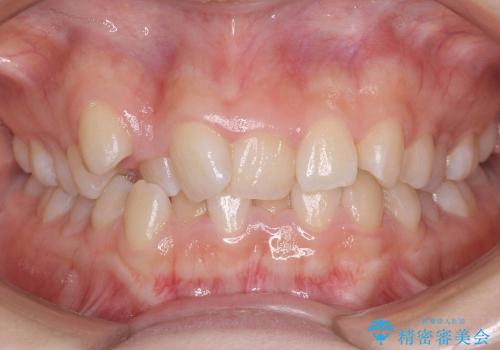 [正中のずれ・前歯のがたがた] 上だけ抜歯で矯正治療の治療前