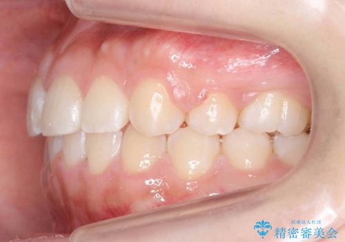 [正中のずれ・前歯のがたがた] 上だけ抜歯で矯正治療の治療後