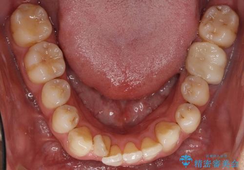 [30代男性　受け口] 歯を抜かない矯正治療の治療前