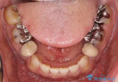 [40代男性・受け口] 下のみ抜歯の矯正治療の治療後