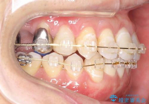 [30代男性　受け口] 歯を抜かない矯正治療の治療中
