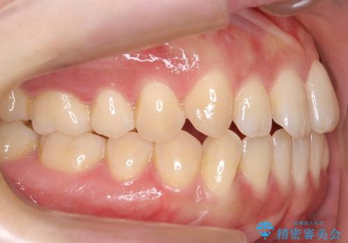 [軽度叢生と臼歯の反対咬合] 歯を抜かない矯正治療の治療前