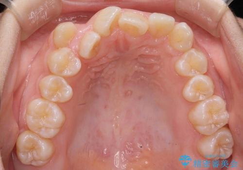 [正中のずれ・前歯のがたがた] 上だけ抜歯で矯正治療の治療前
